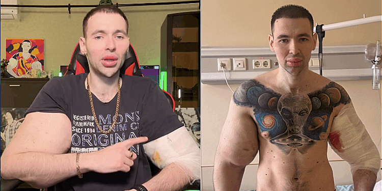 Russian Popeye Kirill Tereshin at Risk of Double Arm Amputation After Severe Infection from Synthol Use